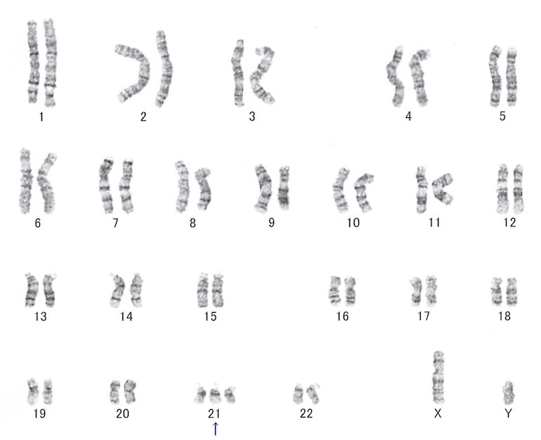 21トリソミーの染色体
